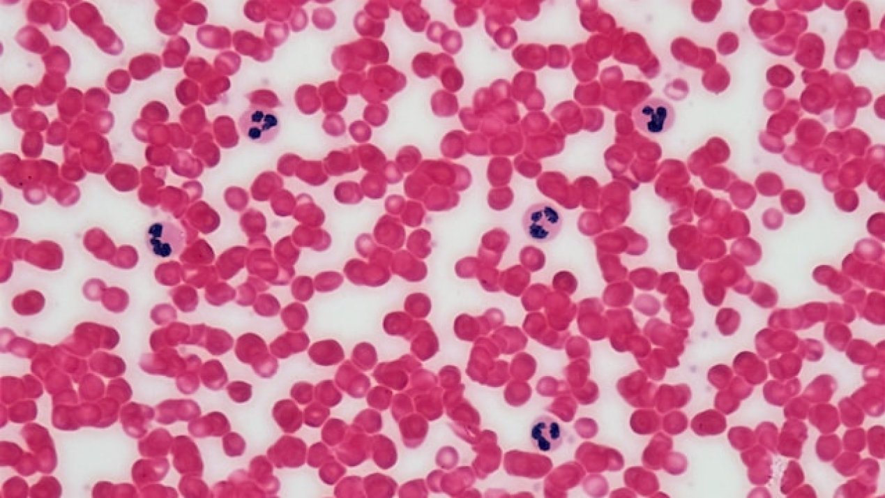 Novo Nordisk to Present New Hemophilia Research 