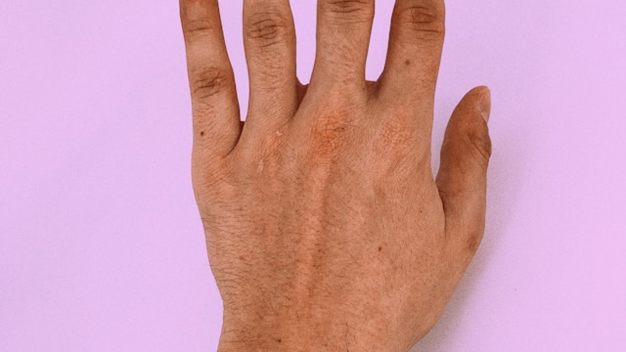 Mexican Health Expert Warns of Rising Melanoma Risks