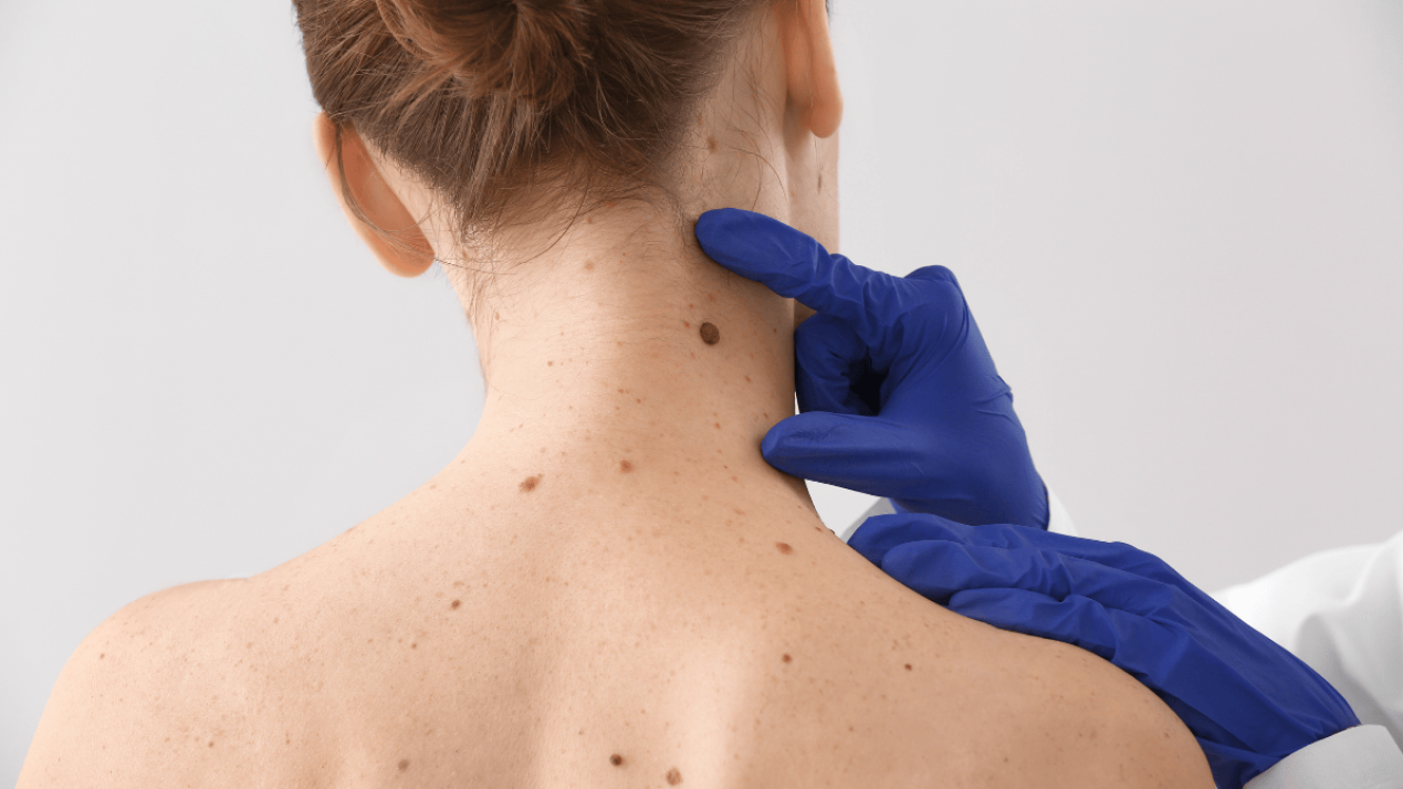 Pembrolizumab Shows 90% Success in Rare Melanoma Trial