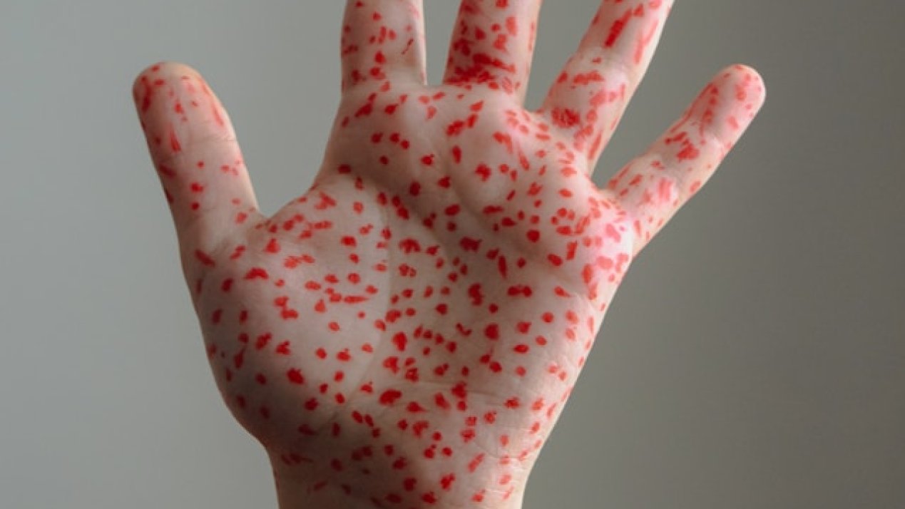 Mexico’s Measles Cases Increase; Region Loses Measles-Free Status