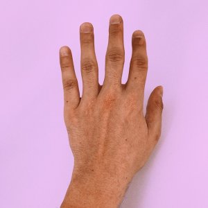 Mexican Health Expert Warns of Rising Melanoma Risks