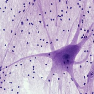 Neurologists Update Criteria to Accelerate MS Diagnosis